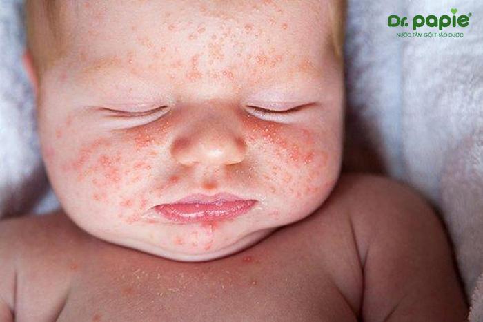 Các vết thương hở vùng mụn rôm sảy dễ dẫn tới nhiễm trùng gây nên sẹo vĩnh viễn cho bé