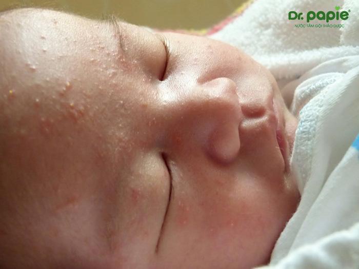 Mụn sữa mọc ở mắt trẻ sơ sinh