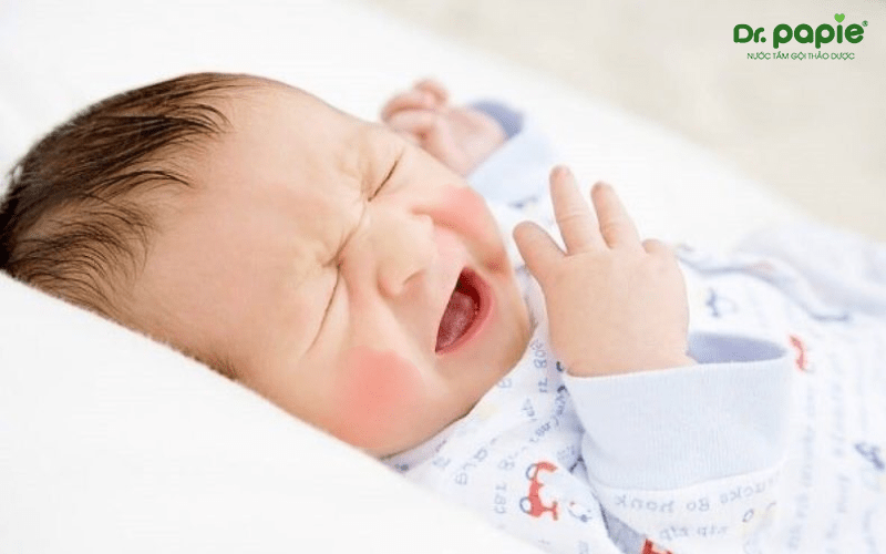 viêm da ở trẻ sơ sinh