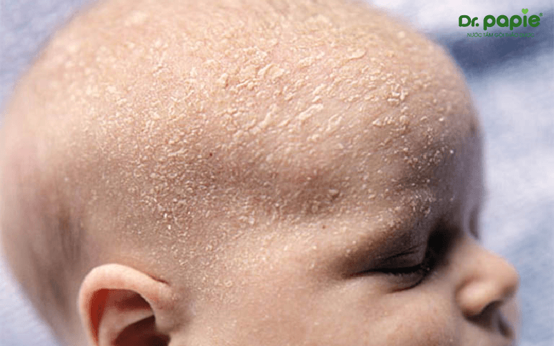 da đầu trẻ sơ sinh có vảy trắng